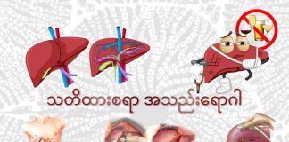 အသည်းကင်ဆာရောဂါ Hepatocellular Carcinoma