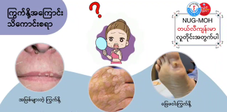 ကြွက်နို့အကြောင်း သိကောင်းစရာ Warts ( June, 2022 )