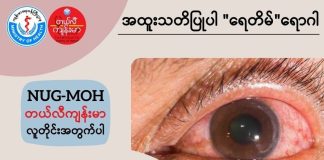 ရေတိမ် Glaucoma ( July, 2022 )
