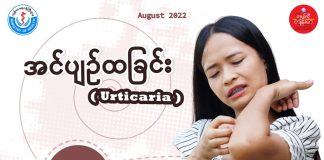 အင်ပျဉ်ထခြင်း Urticaria ( August, 2022 )