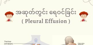အဆုတ်ထဲ ရေဝင်ခြင်း Pleural Effusion ( August, 2022 )
