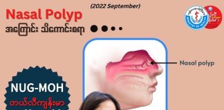 နှာခေါင်းနဲ့ နှာခေါင်းတွင်းလမ်းကြောင်းတလျှောက်မှာ ဖြစ်တတ်တဲ့ အလုံးအကျိတ် တစ်မျိုး Nasal Polyps (September, 2022)