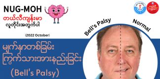 မျက်နှာတစ်ခြမ်းရှိကြွက်သား အားနည်းခြင်း Bell’s Palsy (October, 2022)