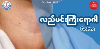 လည်ပင်းကြီးရောဂါ Goitre (October, 2022)