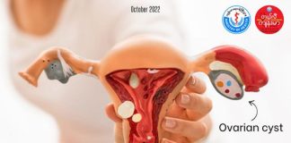 သားဥအိမ် ရေအိတ်ရောဂါအကြောင်းသိကောင်းစရာ Ovarian Cysts (October, 2022)