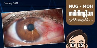 မျက်သားတက်ခြင်း Pterygium