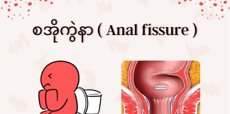 Anal Fissure (စအိုကွဲနာ)(March, 2022)