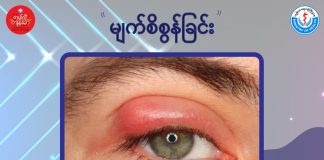 မျက်စိစွန်ခြင်း Stye( March, 2022 )