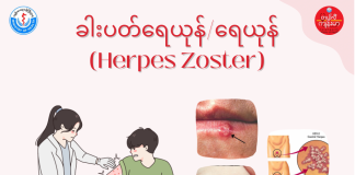 ရေယုန်/ခါးပတ်ရေယုန် Herpes Zoster (Shingles)( April, 2022 )