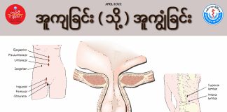 အူကျခြင်း သို့မဟုတ် အူကျွံခြင်း Herniation ( April, 2022 )