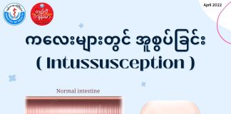 ကလေးအူစွပ်ခြင်း Childhood Intussusception ( April, 2022 )