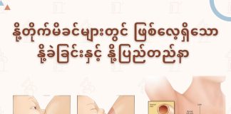 နို့တိုက်မိခင်များတွင်ဖြစ်လေ့ရှိသော နို့ခဲခြင်းနှင့် နို့ပြည်တည်နာ ( April, 2022 )