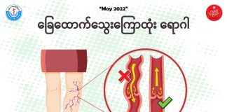 ခြေထောက်သွေးကြောထုံးရောဂါ အကြောင်း Varicose Vein ( May, 2022 )