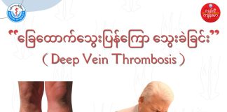 ခြေထောက်သွေးပြန်ကြော သွေးခဲခြင်း Deep Vein Thrombosis ( May, 2022 )