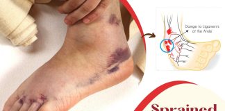 ခြေကျင်း၀တ်လည်ခြင်း/ခေါက်ခြင်း Sprained ankle( June, 2022 )