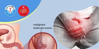 ဝှေးစေ့ကင်ဆာ Testicular Cancer ( July,2022 )