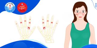 အရေပြားလေးဘက်နာ Systemic Lupus Erythematosus (SLE)( July, 2022 )