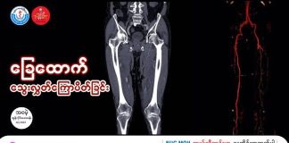 ခြေထောက်ကို ပေးတဲ့ သွေးလွှတ်ကြောတွေမှာ ပြဿနာပေးတဲ့ ကြီးမားတဲ့ရောဂါတစ်ခု Critical Limb Ischemia (CLI)