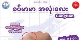 Ganglion (ခပ်မာမာ အလုံးလေး)(September, 2022)