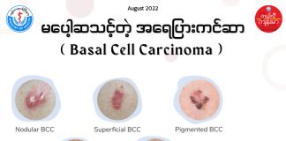 Basal Cell Carcinoma (သို့) အရေပြားကင်ဆာတစ်မျိုး ( August, 2022 )