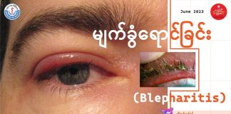 မျက်ခွံရောင်ခြင်း Blepharitis