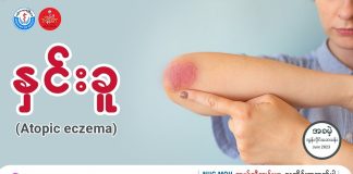 နှင်းခူ Atopic Eczema
